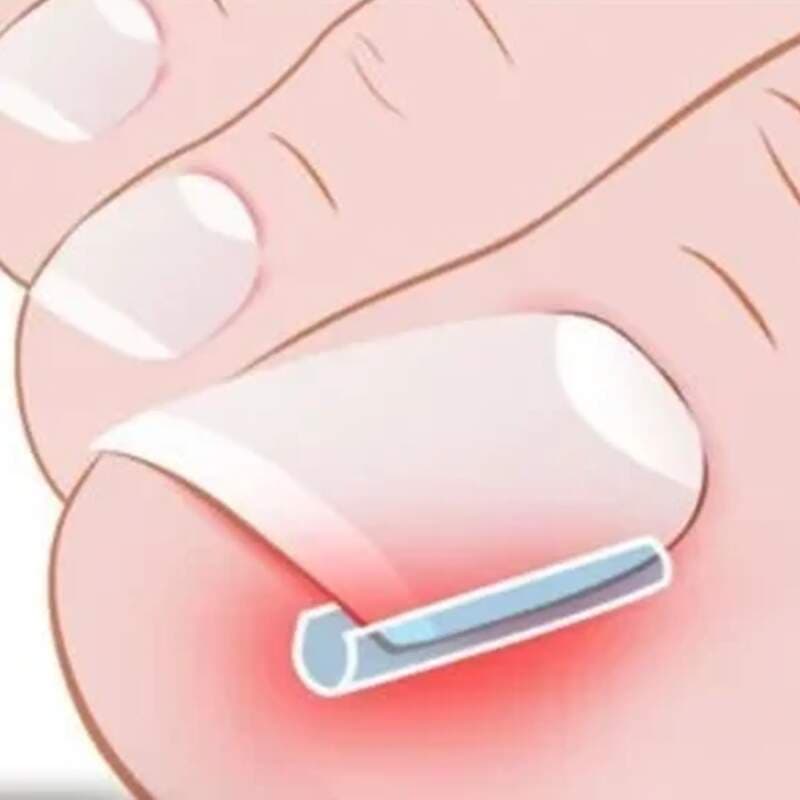 Starnails Podologická sonda Basic - dlátko na nehty, 140mm - náhled 3